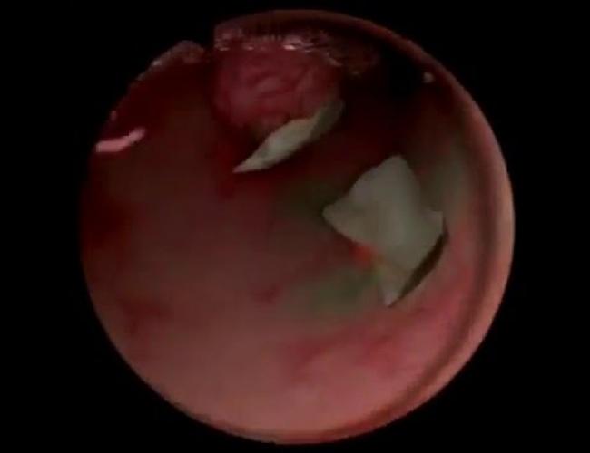 Histeroskopik polip ameliyatı videosu